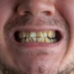 Get Effective Solutions to Restore Your Smile from Chipped Teeth