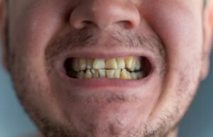 Get Effective Solutions to Restore Your Smile from Chipped Teeth