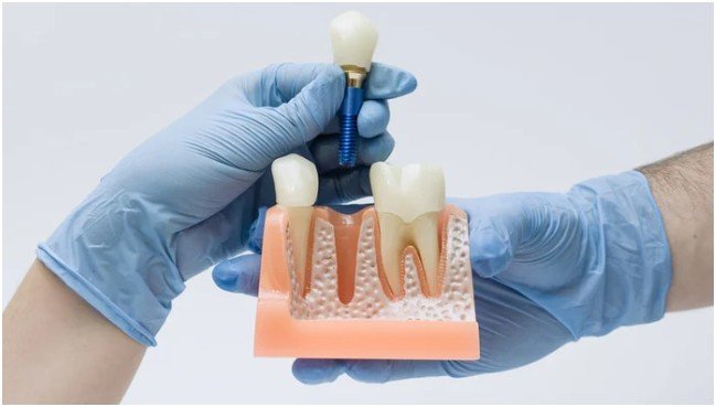 How Dental Implants Restore Comfort