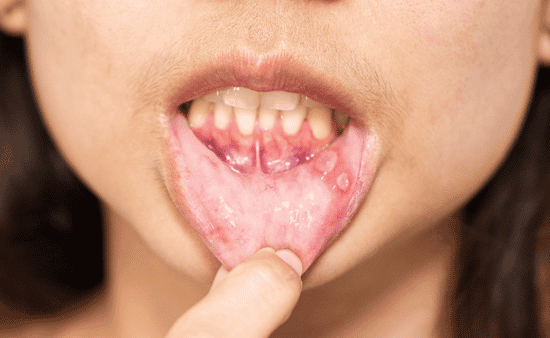 Unusual Sores or Lumps
